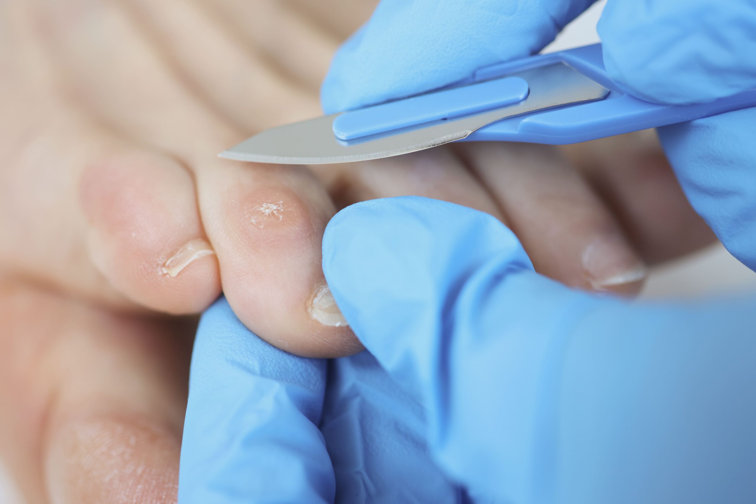 Hühneraugen entfernen – Schmerzfrei durch den Alltag in Berlin