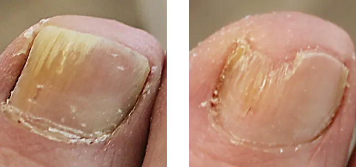 nagelpilzbehandlung ergebnis vorher nacher