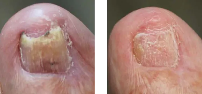 ergebnis nagelpilzbehandlung plasmatherapie