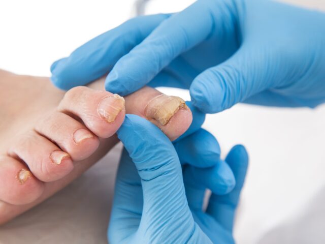 Nagelpilz erkennen: Symptome, Ursachen & der richtige Labortest