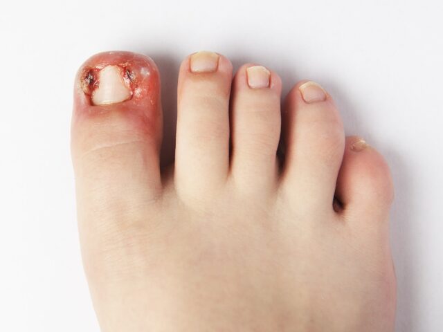 Eingewachsener Zehennagel entfernen: Ursachen, Behandlung & Tipps zur Vorbeugung!