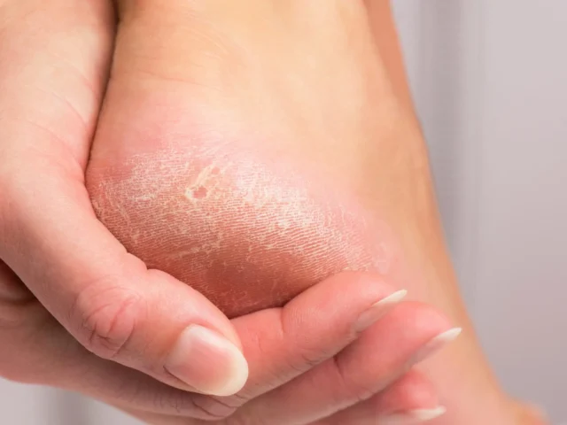 Blasen an den Füßen – Ursachen, schnelle Hilfe & wie Sie sie vermeiden