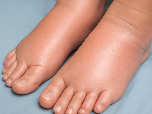 Geschwollene Füße – Ursachen & Behandlung