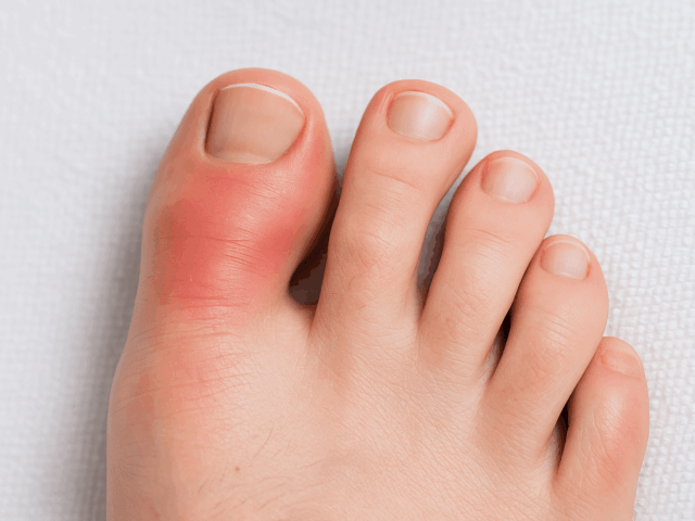 Geschwollene Zehen – Ursachen & Behandlung