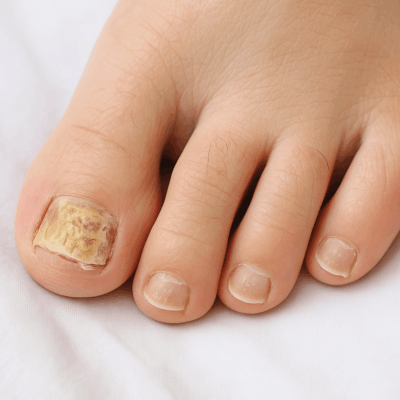 Nagelpsoriasis erkennen