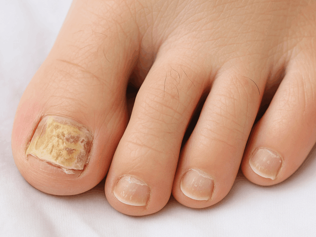 Nagelpsoriasis – wenn Schuppenflechte die Fußnägel befällt