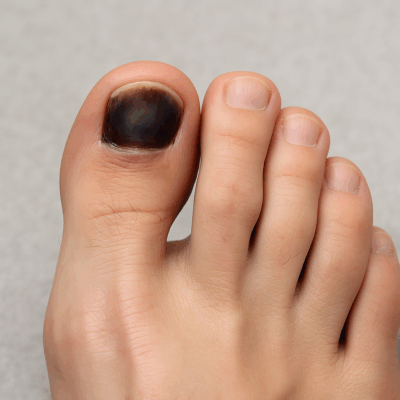 Schwarzer Zehennagel