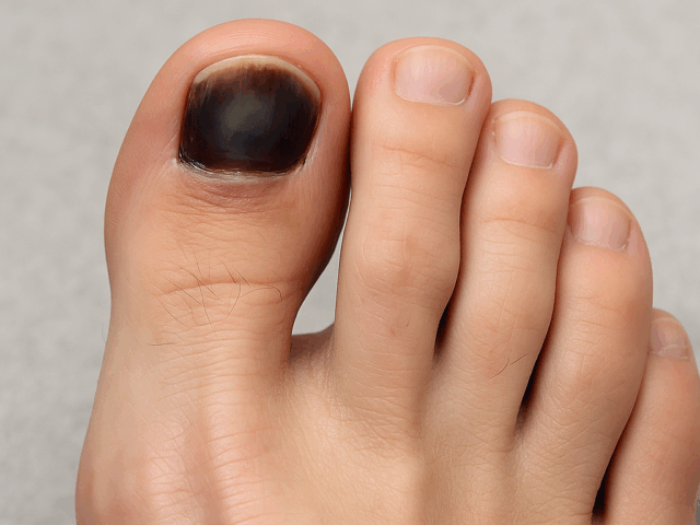 Schwarzer Zehennagel – Ursachen, Symptome & Behandlung beim Podologen in Berlin
