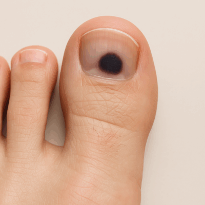 schwarzer fleck unter dem zehennagel