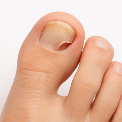 zehennagel fällt ab