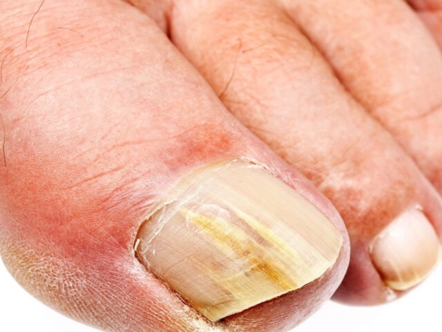 Gelber Zehennagel – Ursachen, Bilder & professionelle Behandlung in Berlin