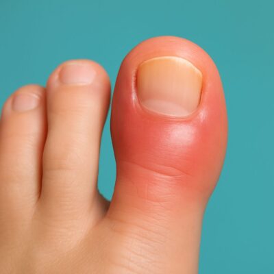 Zeh entzündet Podologie Berlin