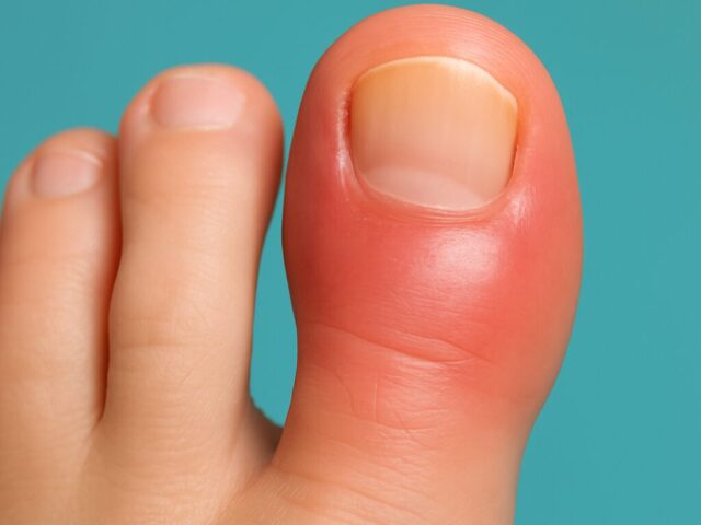 Zeh entzündet – Ursachen, Bilder & wann Podologie Berlin nötig ist