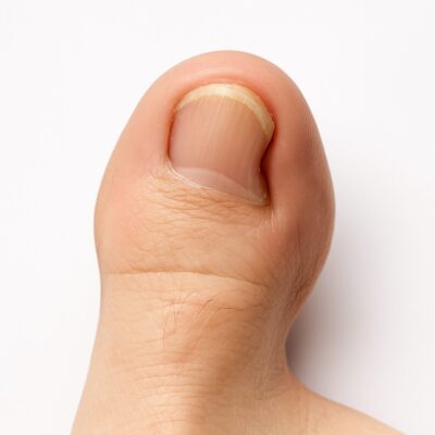 zehennagel wächst schief