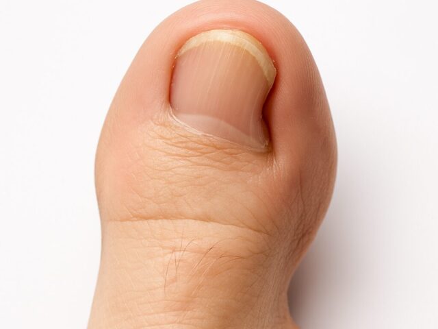 Zehennagel wächst schief – Ursachen, Symptome & professionelle Korrektur beim Podologen Berlin