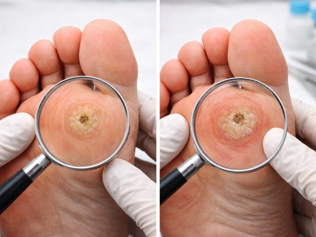 Hühnerauge oder Dornwarze? Der wichtigste Unterschied – inkl. Test & Behandlung