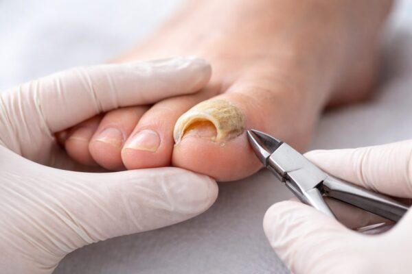 doppelter Zehennagel