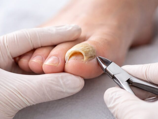 Doppelter Nagel / „Ram’s Horn Nail“ (Widderhornnagel) – selten, aber behandelbar