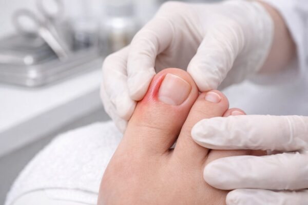 Nagelwallentzündung