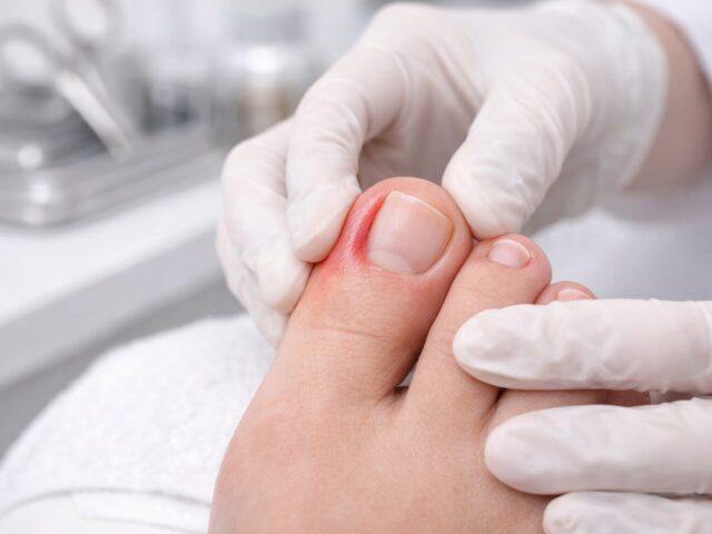 Nagelwallentzündung (Paronychie): Frühzeichen, Sofortmaßnahmen & wann Podologie nötig ist