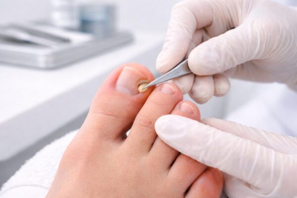 Hühnerauge behandeln