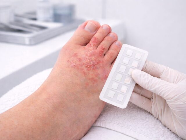 Kontaktallergien am Fuß: Schuhe, Kleber, Cremes – typische Auslöser & Tests