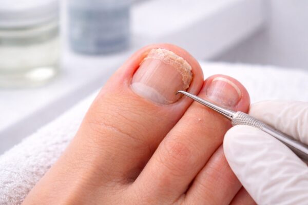 Onycholyse nach Gel Pediküre