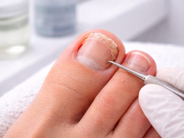 Onycholyse (Nagel löst sich) nach Gel- oder Shellac-Pediküre: Ursachen, Risiken & richtige Behandlung