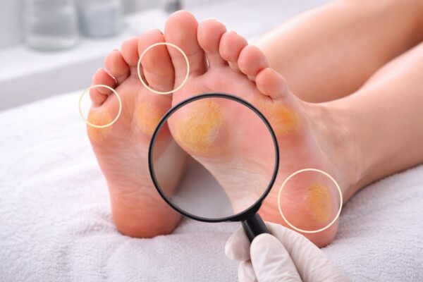 Hornhaut an bestimmten Stellen