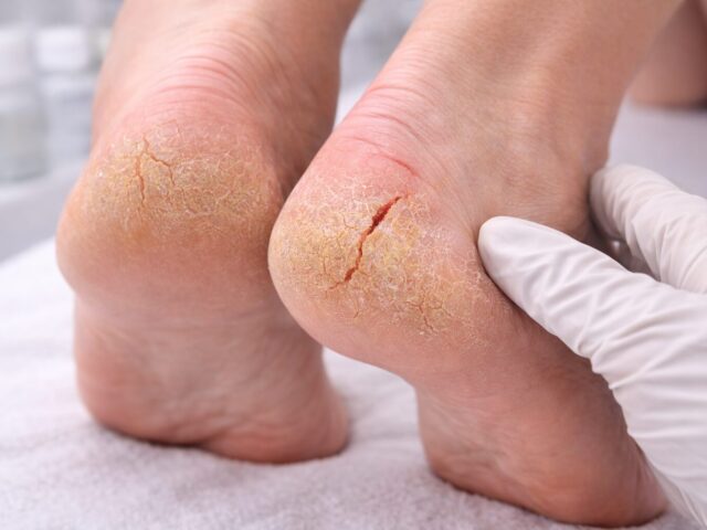 Fersenrisse bei Diabetes/Neuropathie: Warum das ein echtes Risiko ist – und was du jetzt richtig machst (Wundmanagement light)