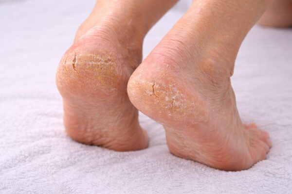 Fußpflege bei sehr trockener Haut