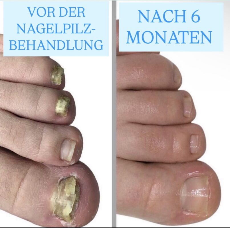 Nagelpilz Kaltplasma