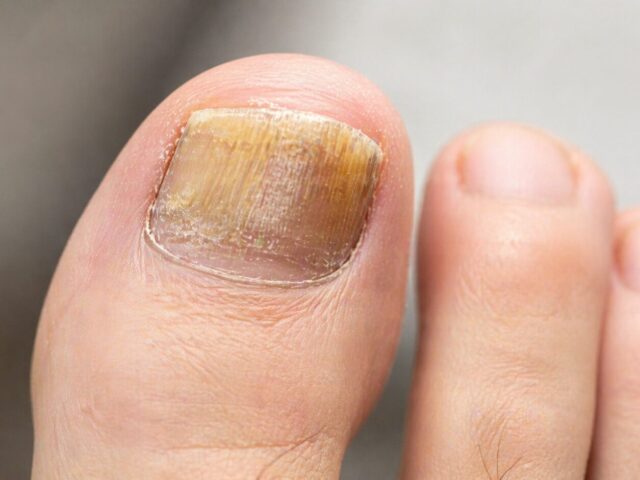 Nagel verdickt und gelb: Ursachen (nicht nur Nagelpilz) – und was du jetzt tun musst