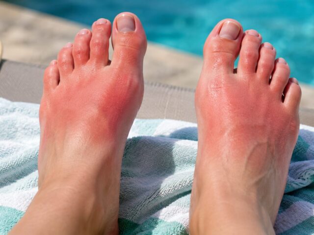 Sonnenbrand an den Füßen: Erste Hilfe + wann es gefährlich wird (und was du ab jetzt anders machen musst)