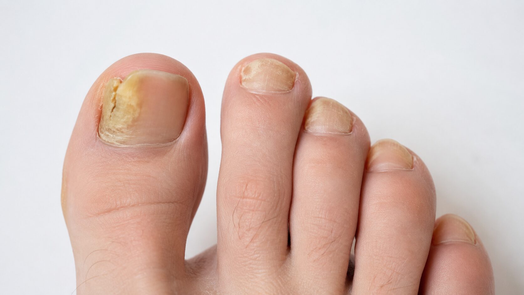 Untersuchung eines eingewachsenen Zehennagels durch eine Podologin