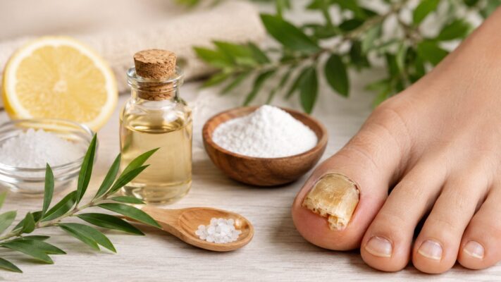 Nagelpilz Hausmittel – verfärbter Zehennagel mit natürlichen Pflegeprodukten