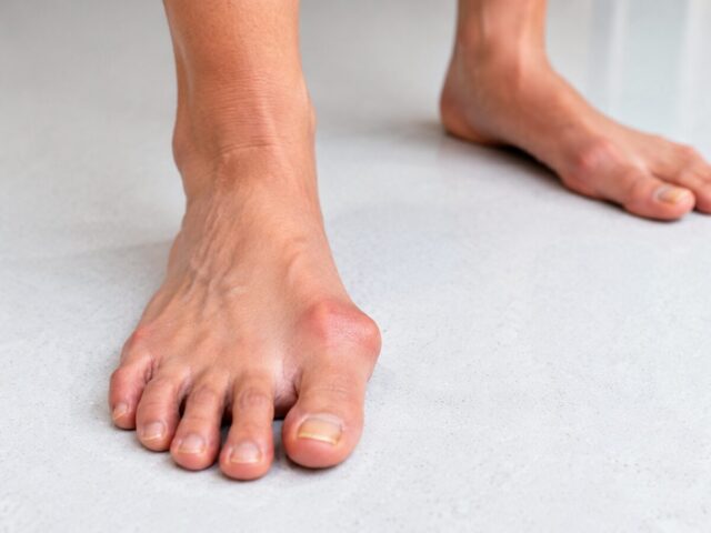 Hallux valgus: Symptome, Behandlung und wann eine Operation sinnvoll ist