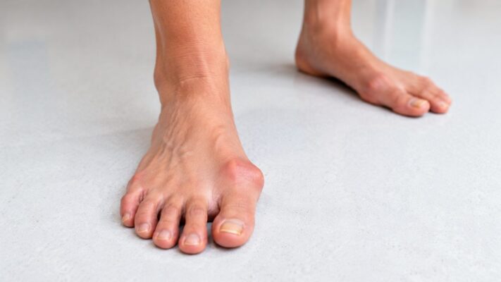 Hallux valgus und Spreizfuß erkennen