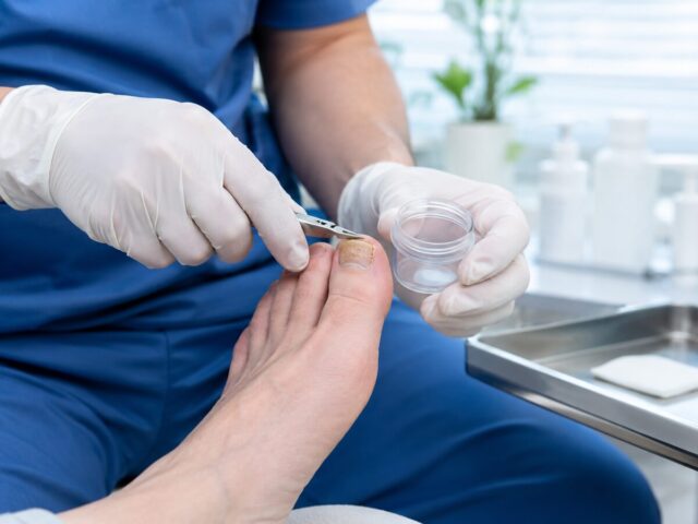 Nagelpilz lasern: Wirkung, Kosten, Risiken und Alternativen