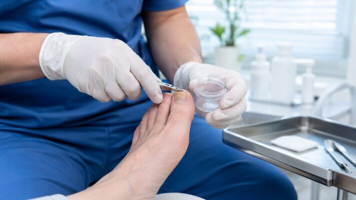 Entnahme von Nagelmaterial für einen Labortest bei Verdacht auf Nagelpilz