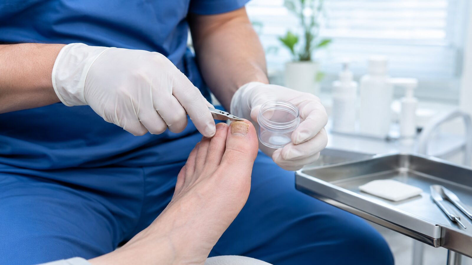 Entnahme von Nagelmaterial für einen Labortest bei Verdacht auf Nagelpilz