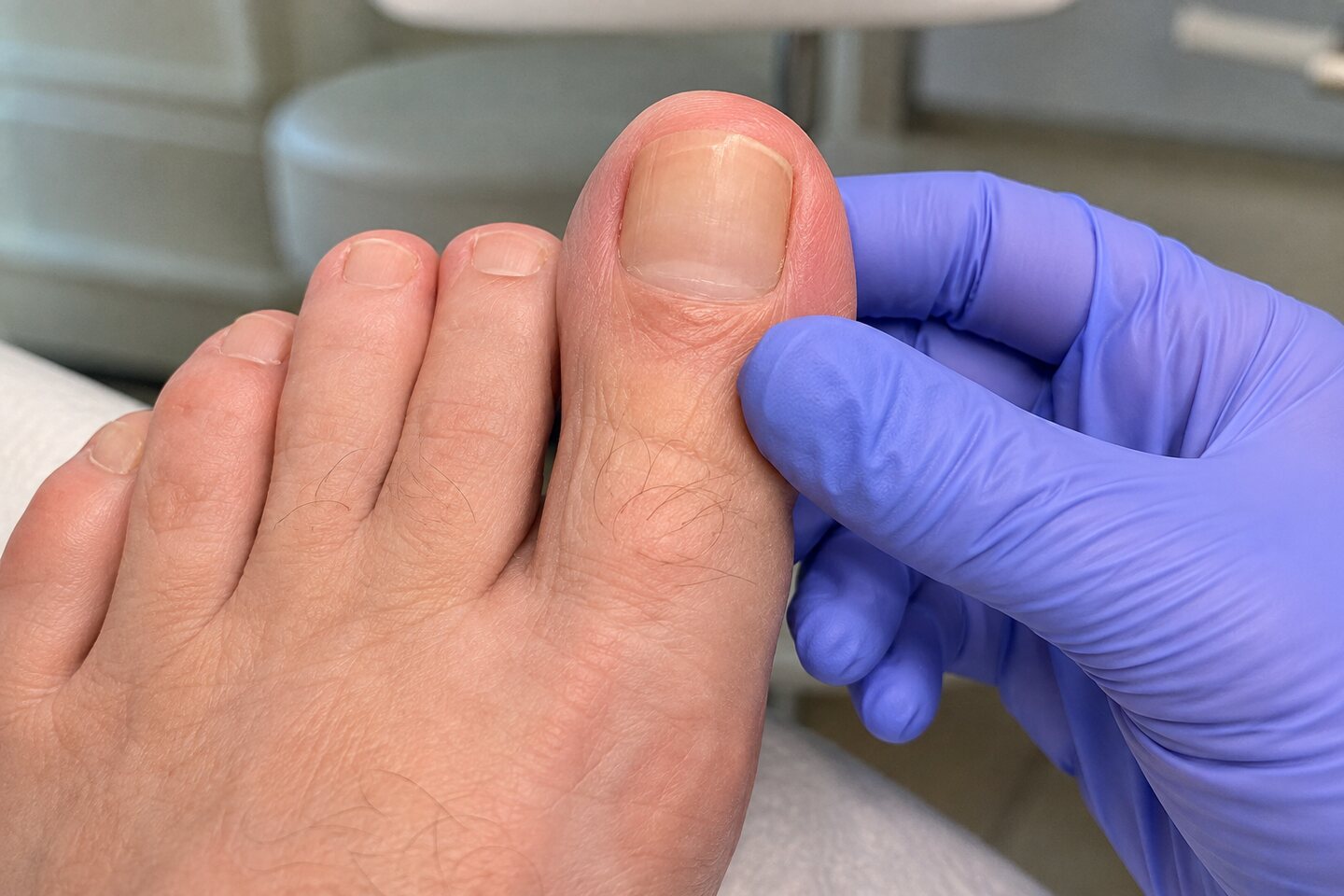 Natürliches Ergebnis einer professionellen Nagelprothetik am großen Zeh