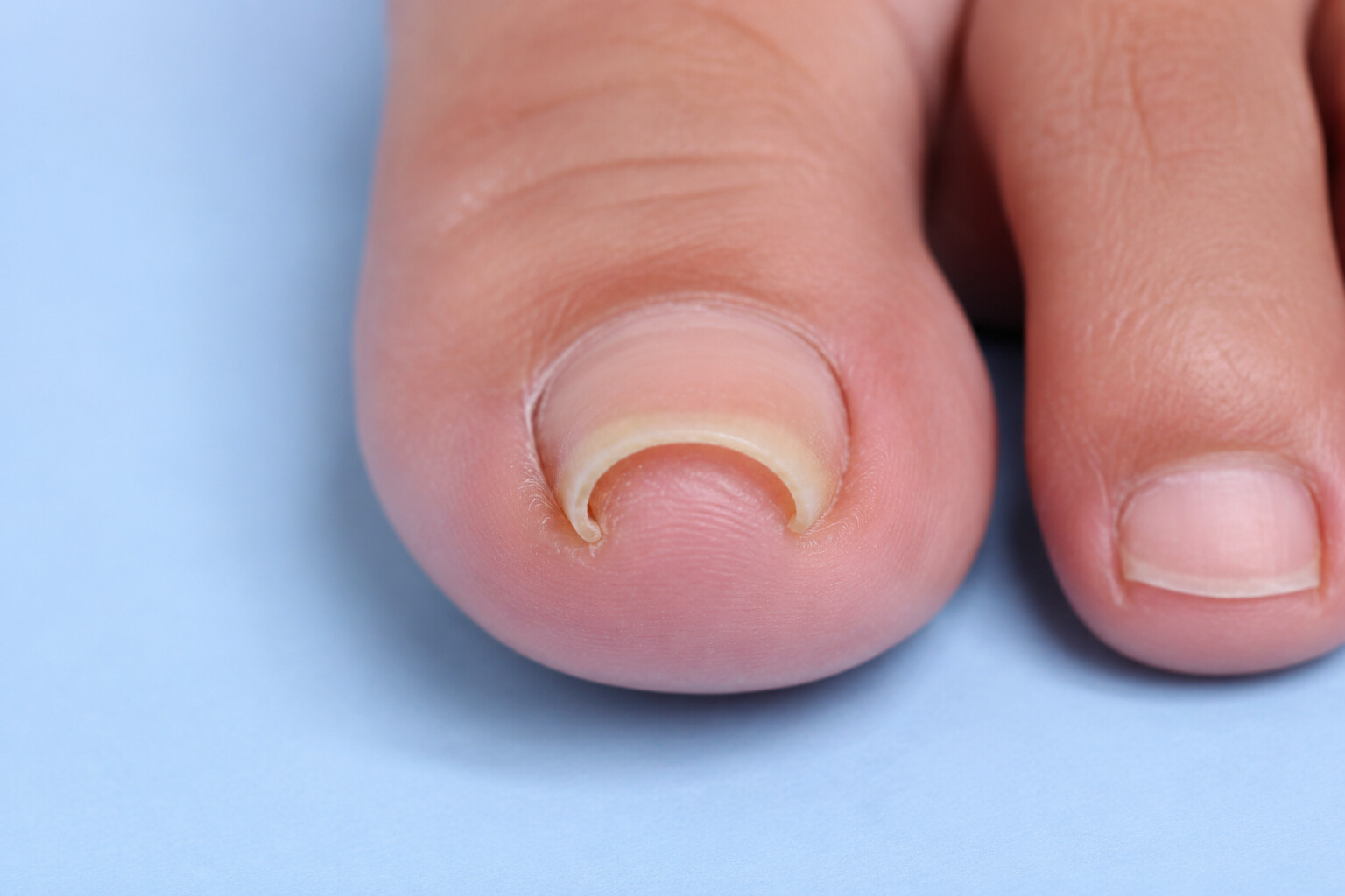 Stark eingerollter Großzehennagel mit klammerförmig gebogenen Nagelrändern