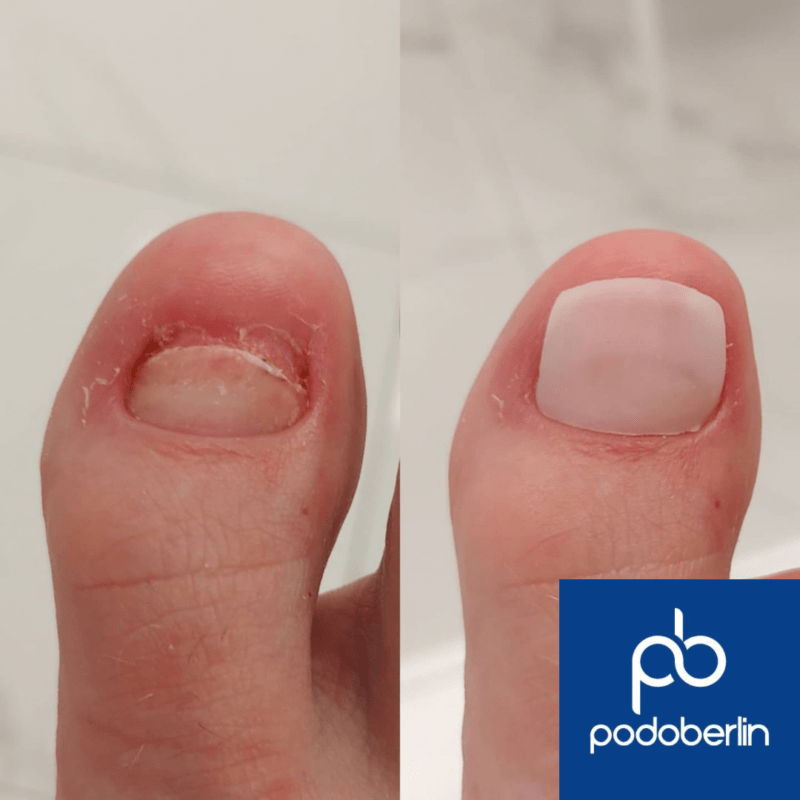 berlin nagelprothetik