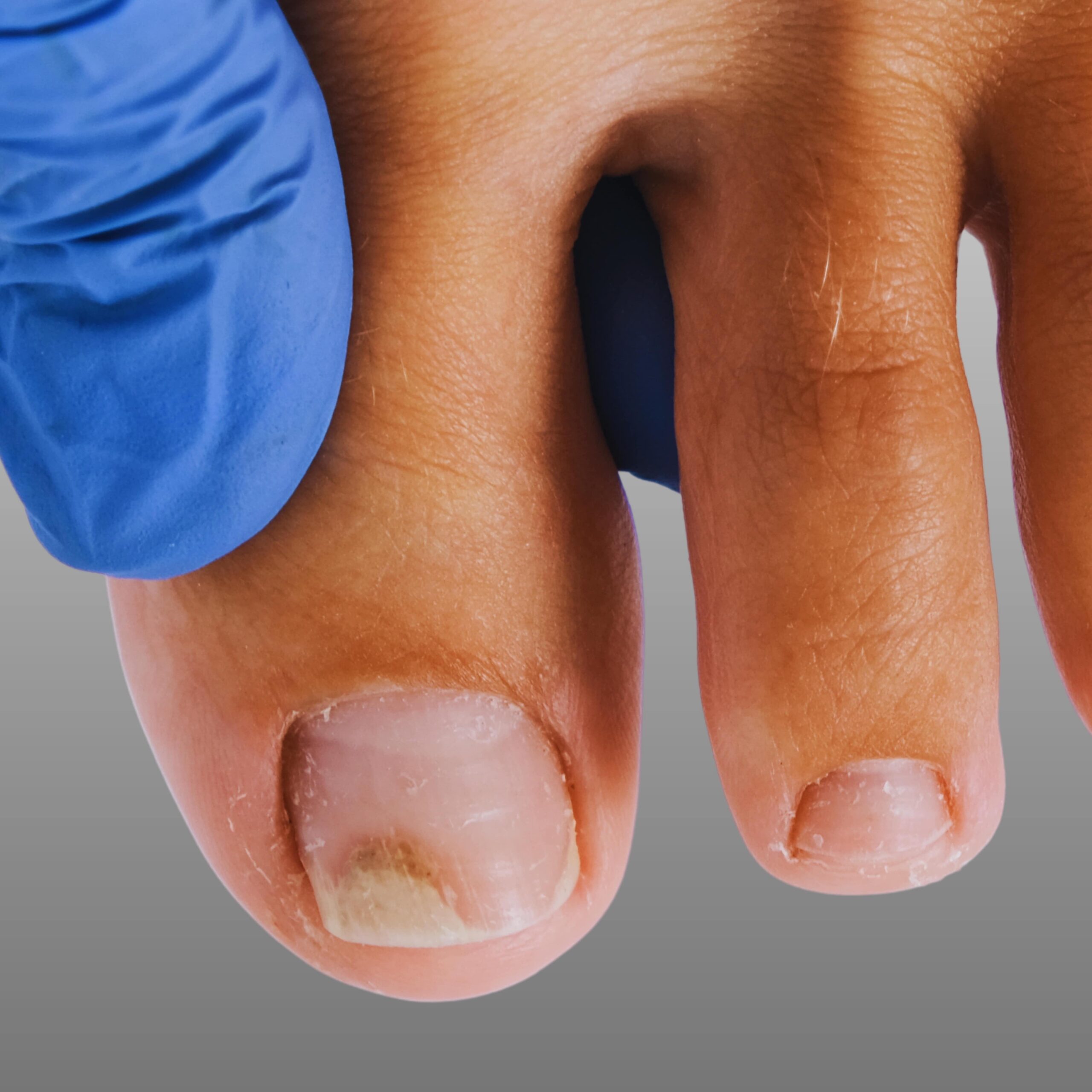 nagelpilzbehandlung berlin
