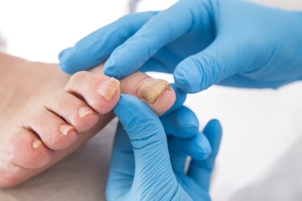 Nagelpilz erkennen